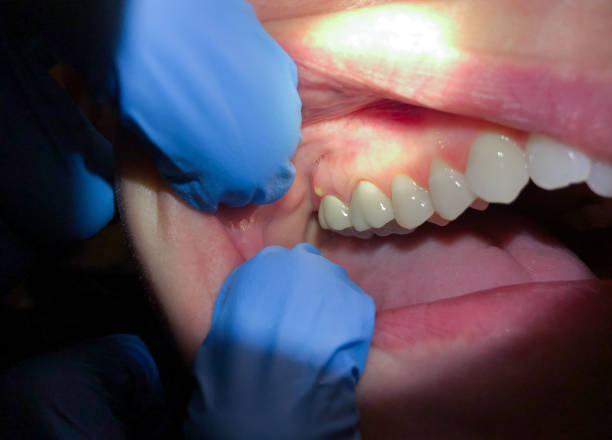 Best Emergency Care for Gum Disease in Mountain Park, GA